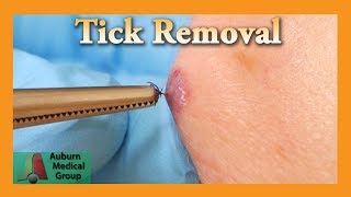 Dead Tick Removal  Auburn Medical Group [upl. by Benoit925]