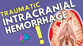 Intracranial Hemorrhage [upl. by Elatnahc896]