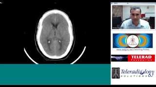 Intracranial Hemorrhage EpiduralSubduralSubarachnoid overview [upl. by Comfort509]