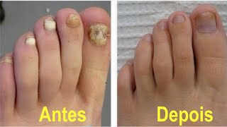 NÃO use muito Esta é a melhor solução para acabar com fungos nas unhas [upl. by Nauqas]