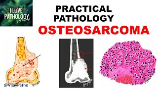 OSTEOSARCOMA Clinical  Radiological features amp Morphology [upl. by Tegdirb291]