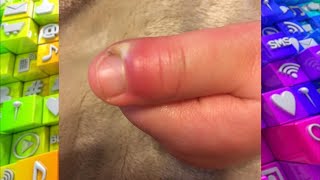 How to Spot an Infection around the Nail [upl. by Linnell]