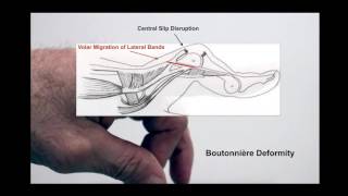 What is a Boutonnière Deformity [upl. by Jamel]