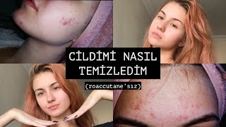 SİVİLCELERİMDEN NASIL KURTULDUM ✨ roaccutane’sız [upl. by Clerk]