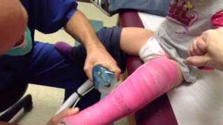 Mimis cast removal [upl. by Orban]