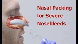 Nasal Packing for Severe Nosebleeds [upl. by Chapman]