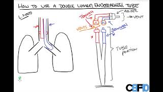 How to use a Double Lumen Endotracheal Tube [upl. by Yllim]