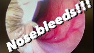 Nosebleeds epistaxis causes prevention treatments and more [upl. by Aveer760]