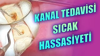 Kanal Tedavisi Sonrası Sıcak Ağrısı Olur mu [upl. by Raddi]