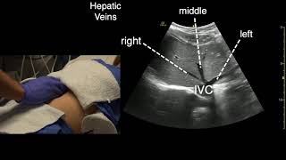 Transverse Liver Scan Technique [upl. by Alicul]