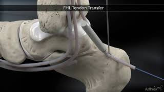 Flexor Hallucis Longus FHL Tendon Transfer [upl. by Evalyn]