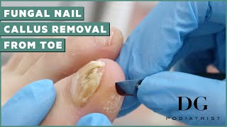 Fungal Nail Treatment And Callus Removal  The Foot Scraper DG Podiatrist [upl. by Winne]