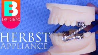 BRACES EXPLAINED Herbst Appliance [upl. by Arua]