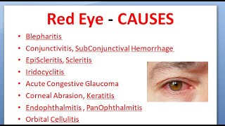 Diseases of Eyelid 1 Chalazion ophthalmology by JD [upl. by Llertnod441]