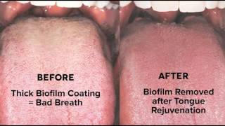 Tongue Rejuvenation  Cure Bad Breath Biofilm amp Halitosis 7035330927 [upl. by Ayanad827]