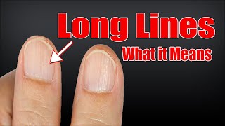 10 Ways To Get Rid of Vertical Ridges On Nails as Per Dermatologist [upl. by Atteiram]