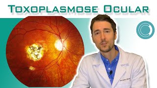 Toxoplasmose ocular  tratamento [upl. by Brebner]