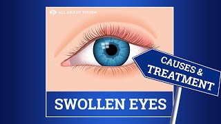 Swollen Eyelid Causes amp Treatment [upl. by Fraze]