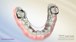 Bi HelixLower Orthodontic Appliance [upl. by Oba19]