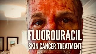 Fluorouracil Skin Treatment  Before During and After [upl. by Tait191]