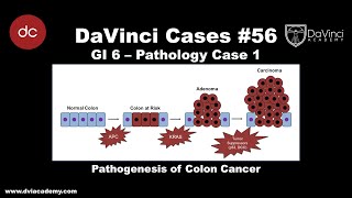 Pathogenesis of Colon Cancer DaVinciCases GI 6  Pathology Case 1 [upl. by Drawets712]