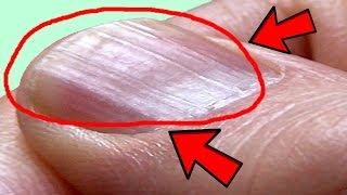 What Causes Ridges in Finger and Toenails [upl. by Siramay]