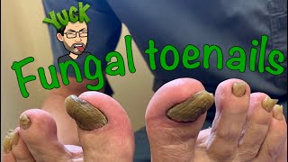 CUTTING LONG TOENAILS WITH FUNGUS [upl. by Pitts290]