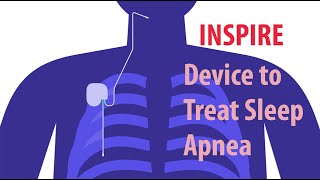 INSPIRE Device to Treat Sleep Apnea [upl. by Lehrer]