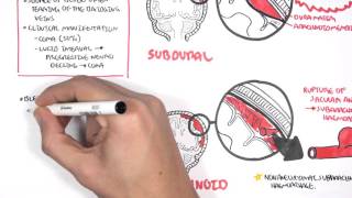 Hemorrhagic stroke epidural amp subdural hematoma  USMLE Step 1 [upl. by Eat651]