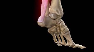 Achilles Tendon Rupture  Complete Anatomy [upl. by Rhynd]