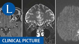 Neurological problems post vaccine against SARSCoV2 [upl. by Adnomal]