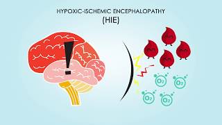 Cerebral Palsy Etiology Pathophysiology Complications Treatment [upl. by Ester]