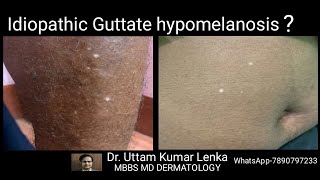 White spots on skin in old age idiopathic guttate hypomelanosis Treatment and prevention [upl. by Yelrebma]