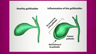 Pain Caused by Gallbladder Inflammation [upl. by Atsillak]