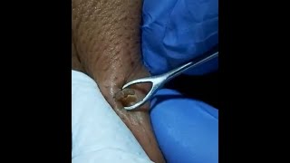 LARGE DEEP BLACKHEAD on back squeezed out Original ASMR [upl. by Byram916]