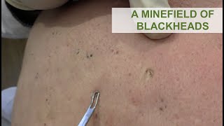 A Minefield of Blackheads  Dr Derm [upl. by Conlon332]