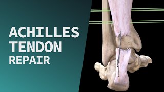 Achilles Tendon Repair [upl. by Athelstan]