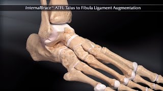 InternalBrace™ ATFL Talus to Fibula Ligament Augmentation [upl. by Timms]