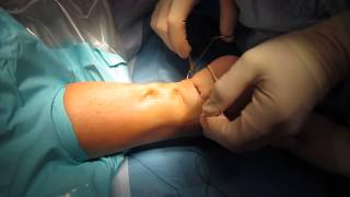 Percutaneous Achilles Tendon Surgery Repair Unedited by Kevin R Stone MD [upl. by Koziarz]