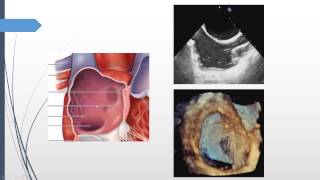 How to image the interatrial septum using 3DTEE quotRATLe90 maneuverquot [upl. by Traggat940]