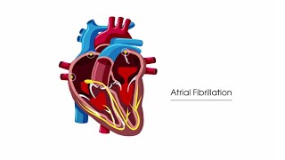 What is atrial fibrillation [upl. by Jackquelin]