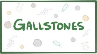 Gallstones cholelithiasis [upl. by Zolly827]