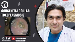 Congenital ocular toxoplasmosis [upl. by Asil]