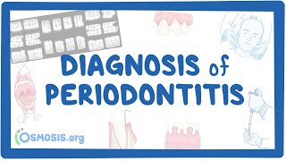 Diagnosis of Periodontitis [upl. by Ellenohs135]