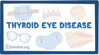 Thyroid Eye Disease causes symptoms diagnosis treatment pathology [upl. by Valaree]