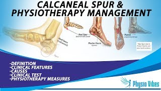 CALCANEAL SPUR amp PHYSIOTHERAPY MANAGEMENT [upl. by Anawqahs41]