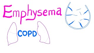 Emphysema  COPD  Pulmonary Medicine [upl. by Pearman]