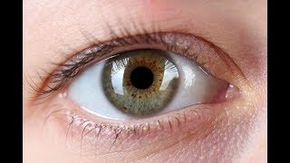 What is Chemosis Eye Inflammation Causes and Symptoms [upl. by Acker]