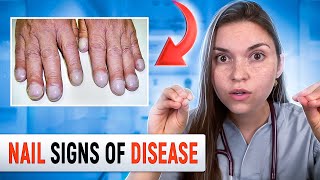 Doctor Explains what your NAILS say about your HEALTH Top 10 Nail Problems [upl. by Nnayhs926]