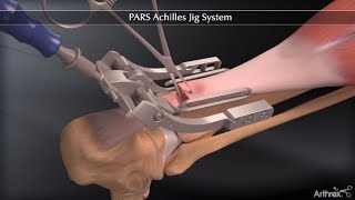 PARS Achilles Jig System [upl. by Snow]